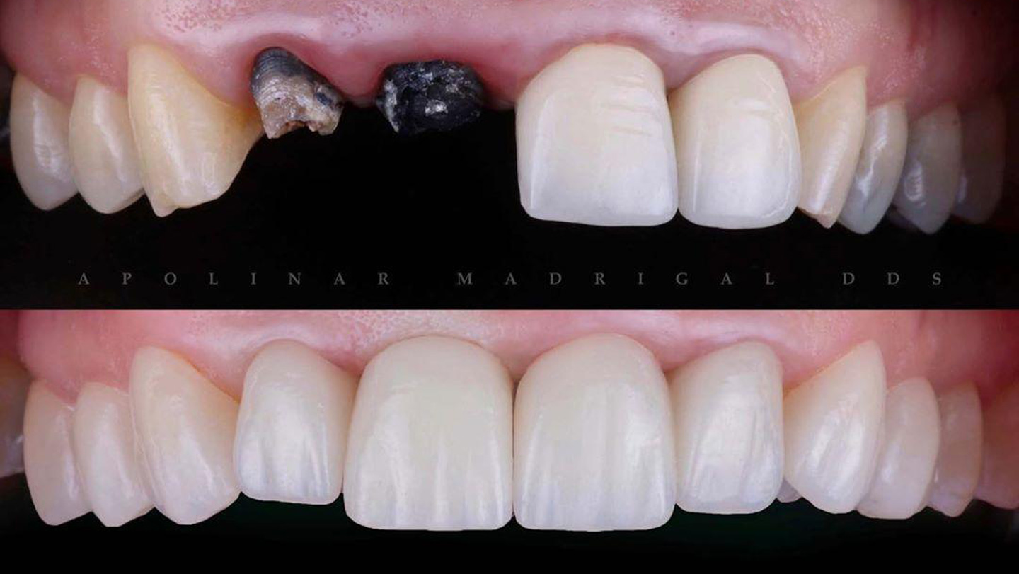 Lumineers Veneers Clinical Dentistry by Dr. Apolinar Madrigal