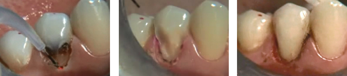 Class V Restoration procedures using a diode dental laser