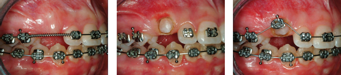 Cuspid Exposure accomplished with dental diode laser