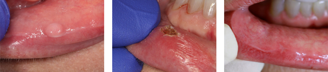 Destruction of a Lesion is quick and easy using a dental laser