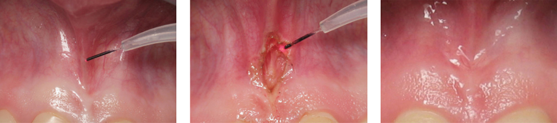 Frenectomy procedures can be accomplished using a soft-tissue dental laser