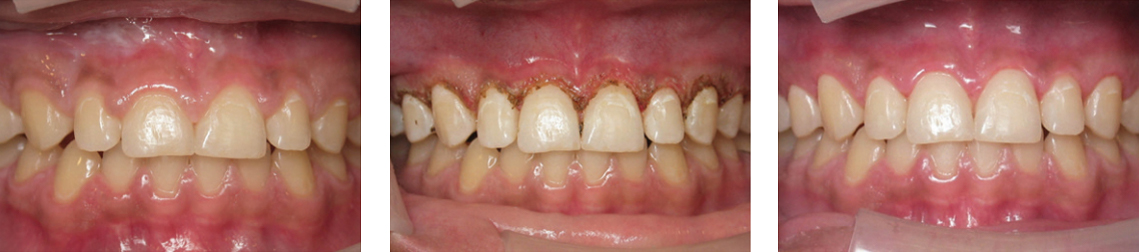 Use a dental laser for Gingivectomy procedures