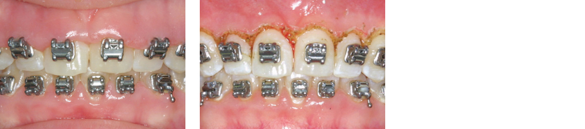 Hyperplasia procedure with dental laser