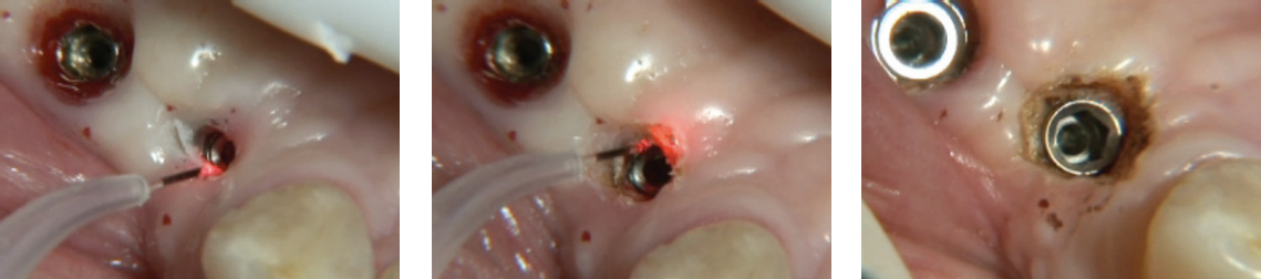 Implant Recovery using a dental laser causes less bleeding than a scalpel