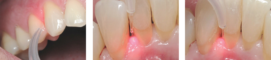 Use a soft-tissue dental laser for Laser Bacterial Reduction procedures