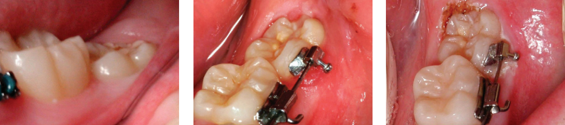 Operculectomy procedures using a dental laser