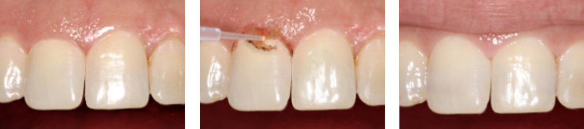 Use a dental laser for Recontouring procedures